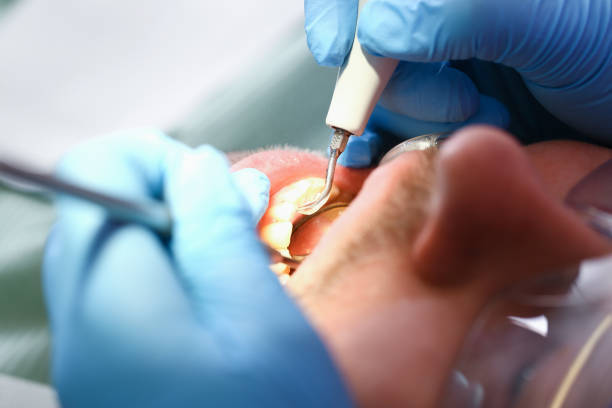 Best Emergency Wisdom Teeth Removal in Walden, TN